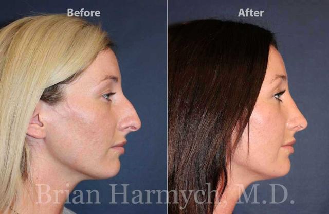 Functional Rhinoplasty result at Harmych Facial Plastic Surgery in Beachwood, OH