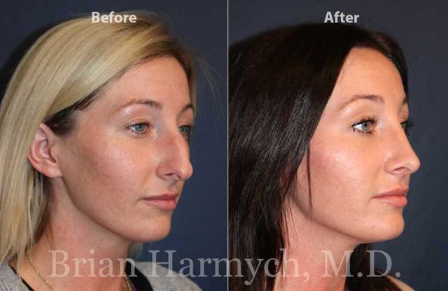 Functional Rhinoplasty result at Harmych Facial Plastic Surgery in Beachwood, OH