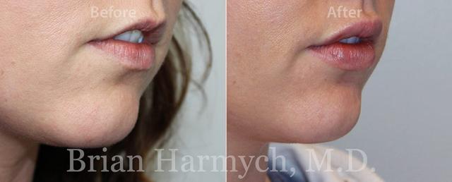 Breast Augmentation result at Harmych Facial Plastic Surgery in Beachwood, OH