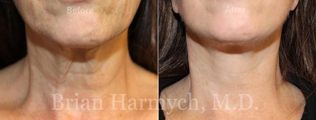 Facelift result at Harmych Facial Plastic Surgery in Beachwood, OH