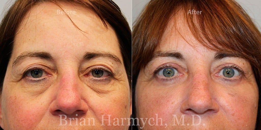 Harmych Facial Plastic Surgery blepharoplasty result — Beachwood, OH