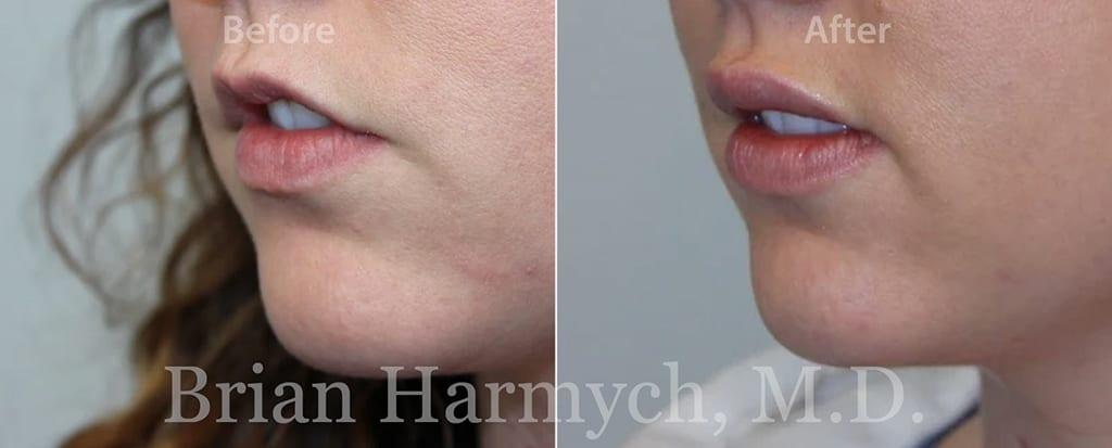 Harmych Facial Plastic Surgery result — Beachwood, OH