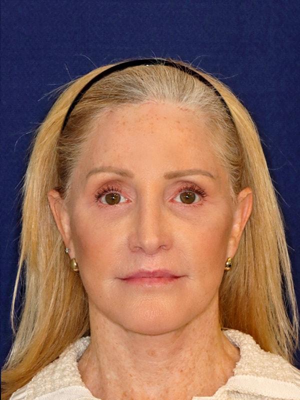 Harmych Facial Plastic Surgery facelift after — Beachwood, OH