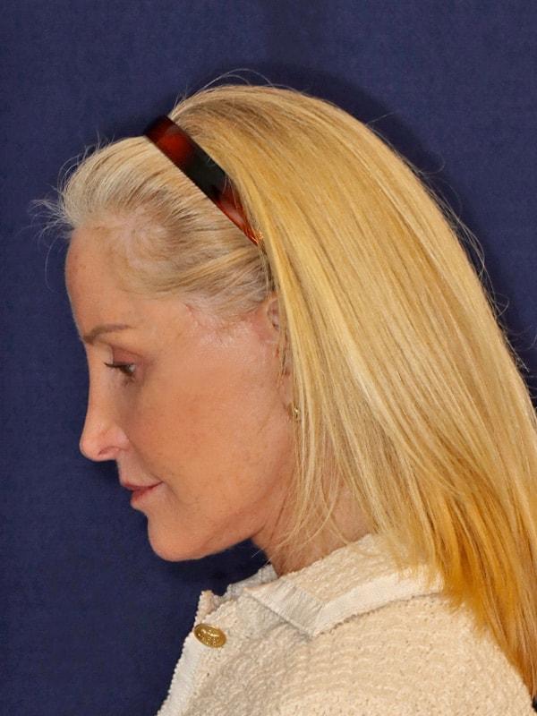 Facelift after at Harmych Facial Plastic Surgery in Beachwood, OH