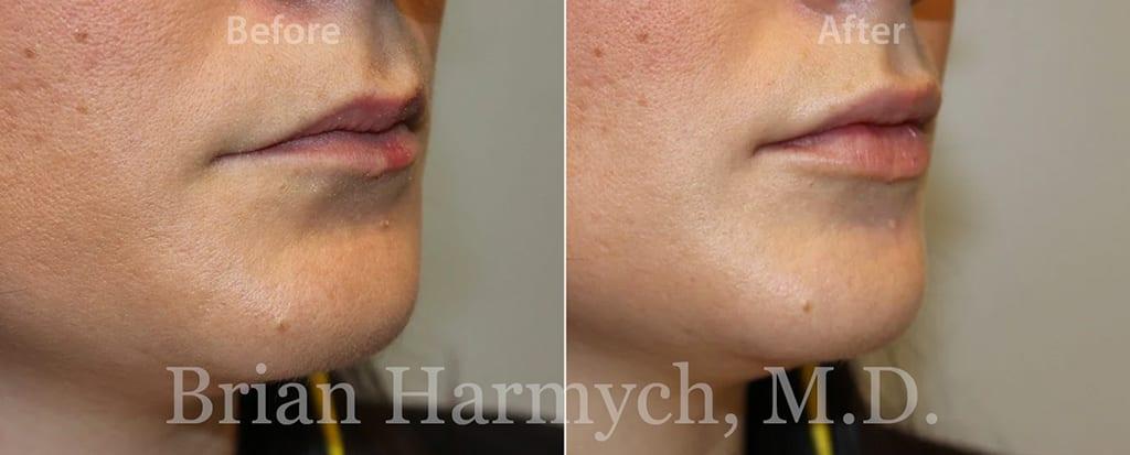 Harmych Facial Plastic Surgery result — Beachwood, OH