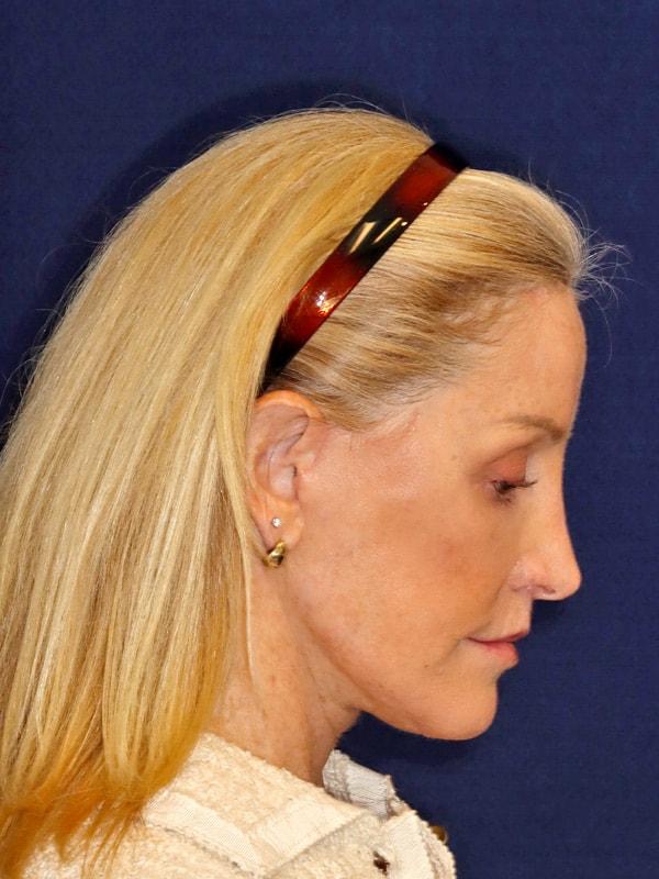 Harmych Facial Plastic Surgery facelift after — Beachwood, OH