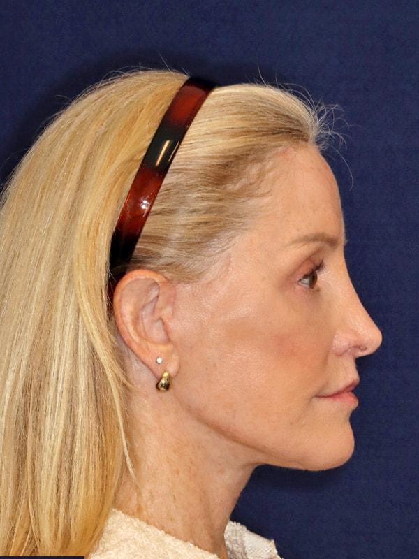Harmych Facial Plastic Surgery facelift after — Beachwood, OH