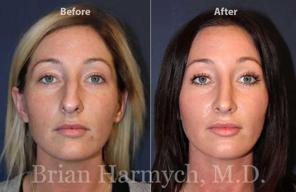 Harmych Facial Plastic Surgery rhinoplasty result — Beachwood, OH