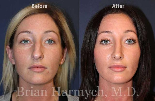 Functional Rhinoplasty result at Harmych Facial Plastic Surgery in Beachwood, OH