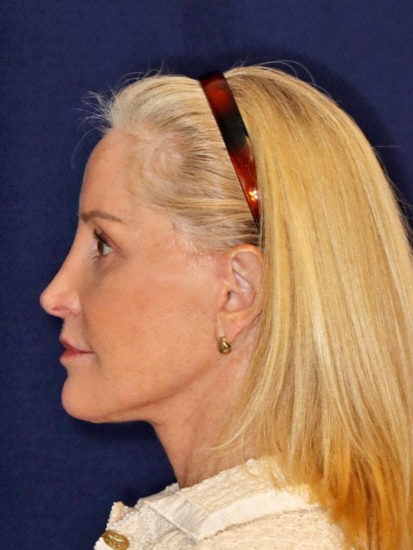 Harmych Facial Plastic Surgery facelift after — Beachwood, OH