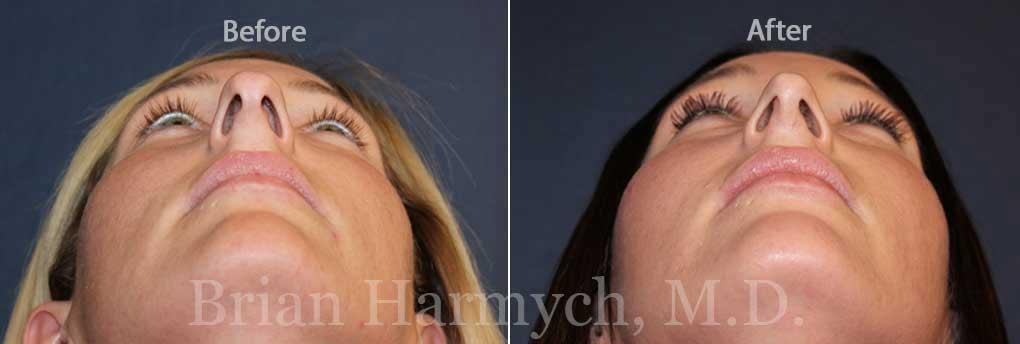 Harmych Facial Plastic Surgery rhinoplasty result — Beachwood, OH