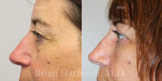 Blepharoplasty result at Harmych Facial Plastic Surgery in Beachwood, OH