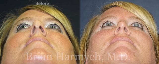 Rhinoplasty result at Harmych Facial Plastic Surgery in Beachwood, OH