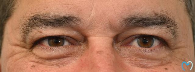 Botox before at Advanced Care Dentistry in Scottsdale, AZ
