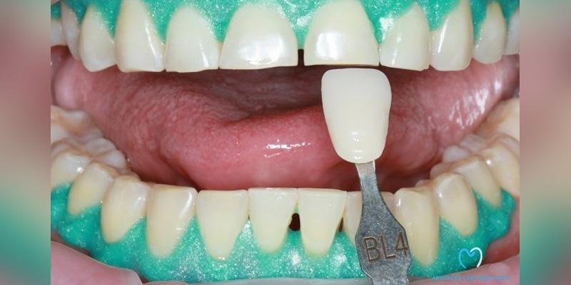 Advanced Care Dentistry smile makeover after — Scottsdale, AZ