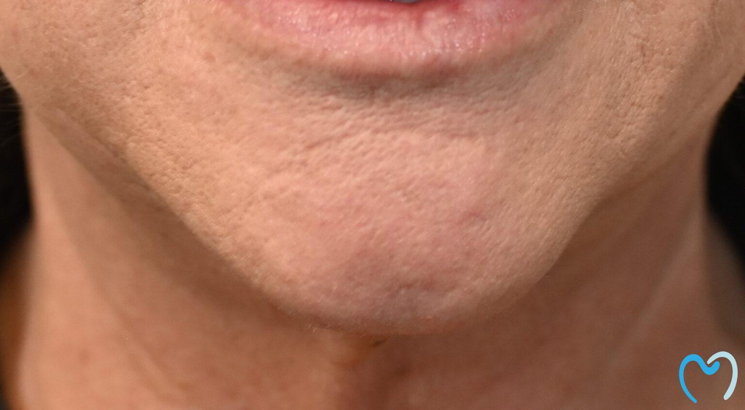 Advanced Care Dentistry smile makeover after — Scottsdale, AZ
