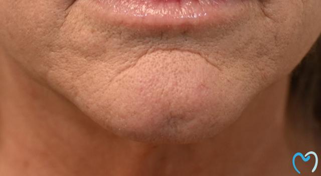 Dental Crowns before at Advanced Care Dentistry in Scottsdale, AZ