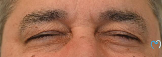Botox after at Advanced Care Dentistry in Scottsdale, AZ
