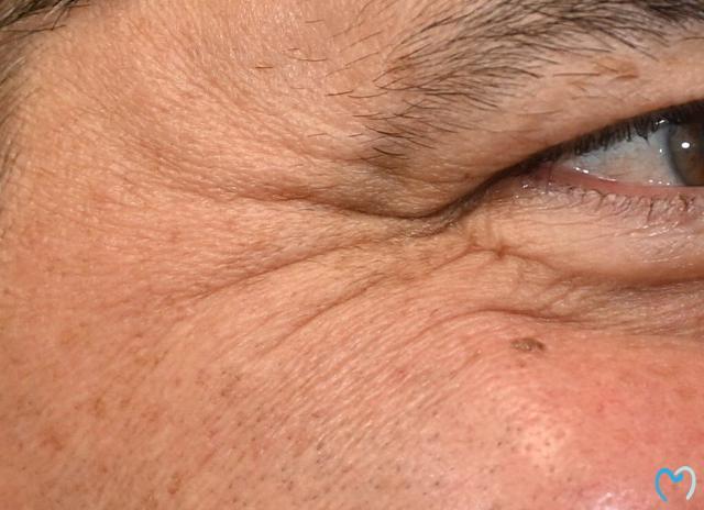 Botox before at Advanced Care Dentistry in Scottsdale, AZ