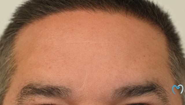 Botox after at Advanced Care Dentistry in Scottsdale, AZ