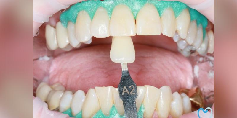 Advanced Care Dentistry smile makeover after — Scottsdale, AZ