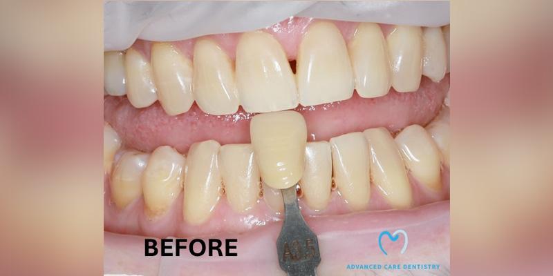Advanced Care Dentistry smile makeover after — Scottsdale, AZ