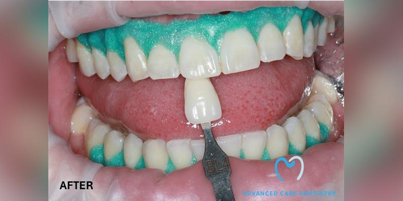 Advanced Care Dentistry smile makeover after — Scottsdale, AZ
