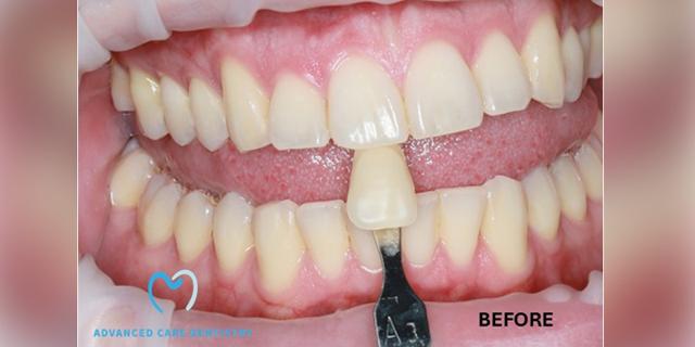 Smile Makeover before at Advanced Care Dentistry in Scottsdale, AZ