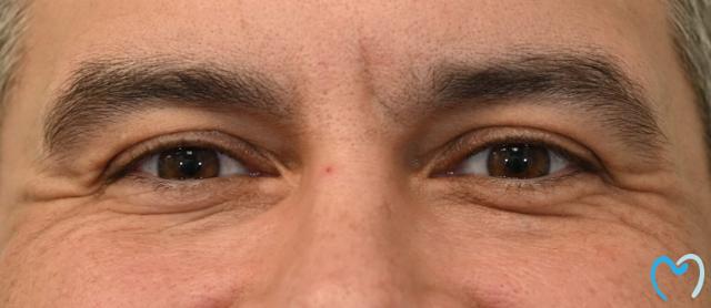 Botox before at Advanced Care Dentistry in Scottsdale, AZ