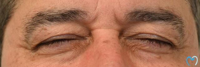Botox before at Advanced Care Dentistry in Scottsdale, AZ