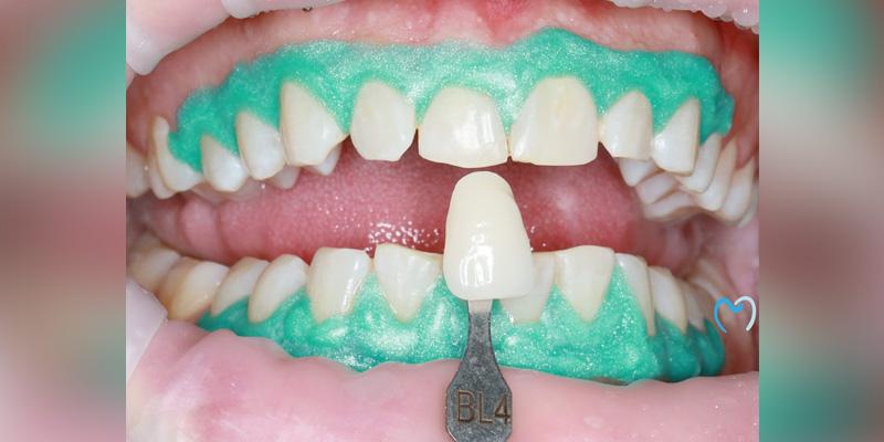Advanced Care Dentistry smile makeover after — Scottsdale, AZ