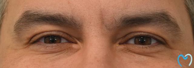 Botox after at Advanced Care Dentistry in Scottsdale, AZ