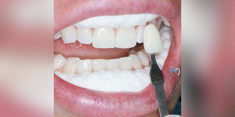 Advanced Care Dentistry smile makeover after — Scottsdale, AZ