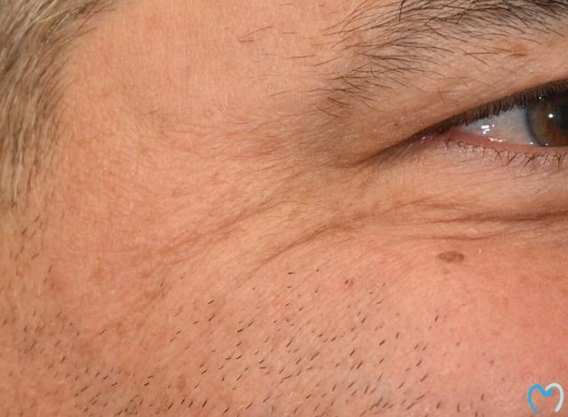 Botox after at Advanced Care Dentistry in Scottsdale, AZ
