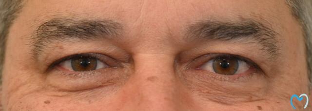 Botox after at Advanced Care Dentistry in Scottsdale, AZ