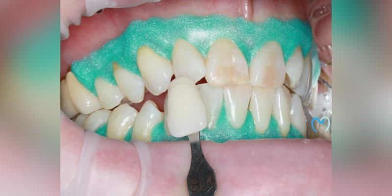 Advanced Care Dentistry smile makeover after — Scottsdale, AZ