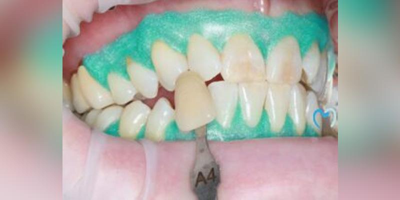 Advanced Care Dentistry smile makeover after — Scottsdale, AZ
