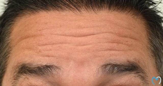Botox before at Advanced Care Dentistry in Scottsdale, AZ