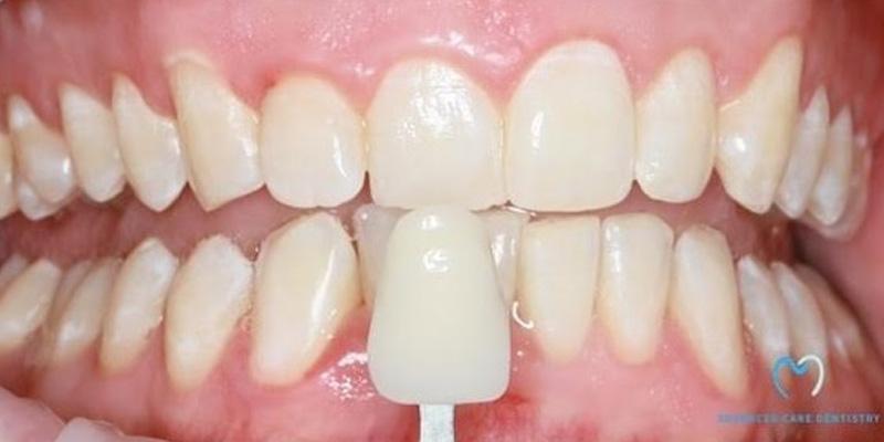 Advanced Care Dentistry smile makeover after — Scottsdale, AZ