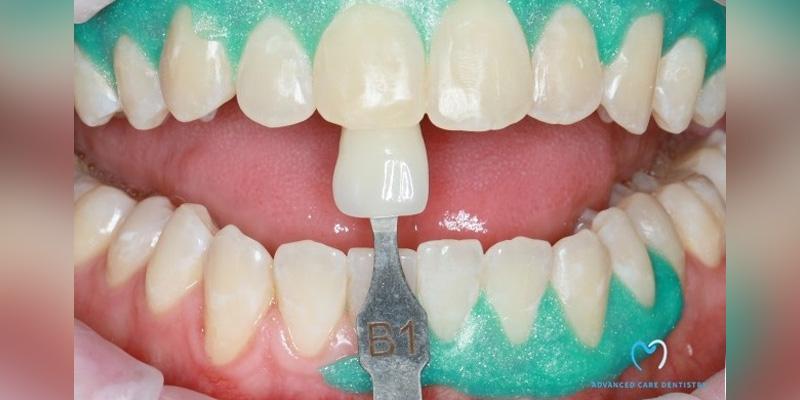 Advanced Care Dentistry smile makeover after — Scottsdale, AZ