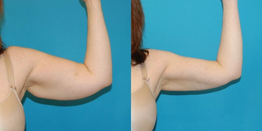 Afshin Parhiscar, MD arm lift result — Walnut Creek, CA