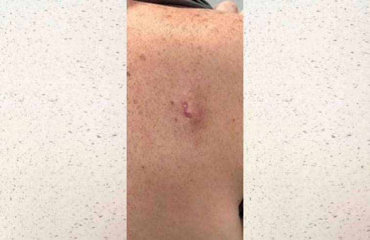 LovelySkin Spa after — Omaha, NE