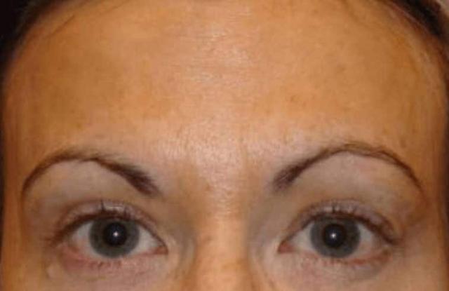 Botox after at LovelySkin Spa in Omaha, NE