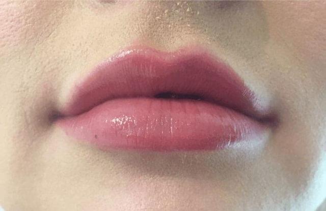 Lip Filler after at LovelySkin Spa in Omaha, NE