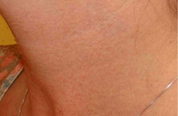 LovelySkin Spa after — Omaha, NE