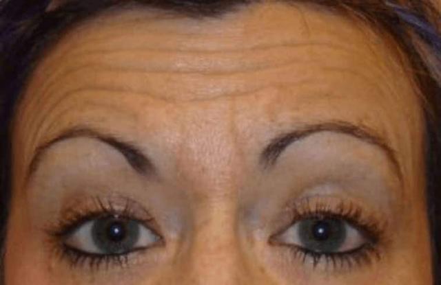 Botox before at LovelySkin Spa in Omaha, NE