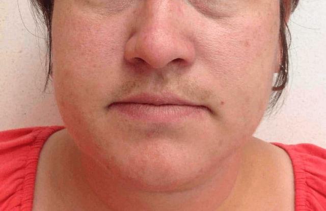 Laser Skin Resurfacing before at LovelySkin Spa in Omaha, NE