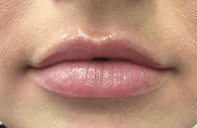 Lip Filler before at LovelySkin Spa in Omaha, NE