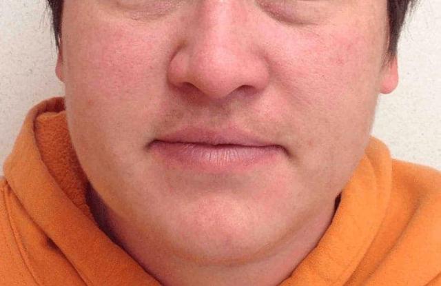 Laser Skin Resurfacing after at LovelySkin Spa in Omaha, NE