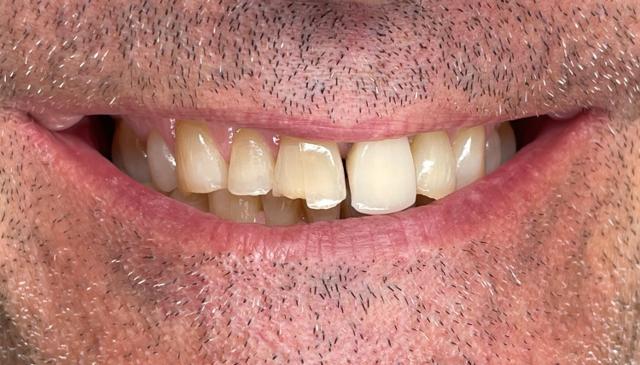 Invisalign before at Cool Springs Family Dentistry, PLLC in Franklin, TN